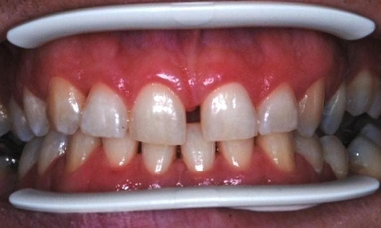 Smile-Makeover-Before-Image